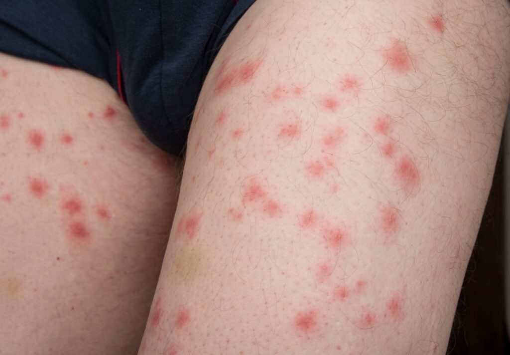 rash from bed bugs